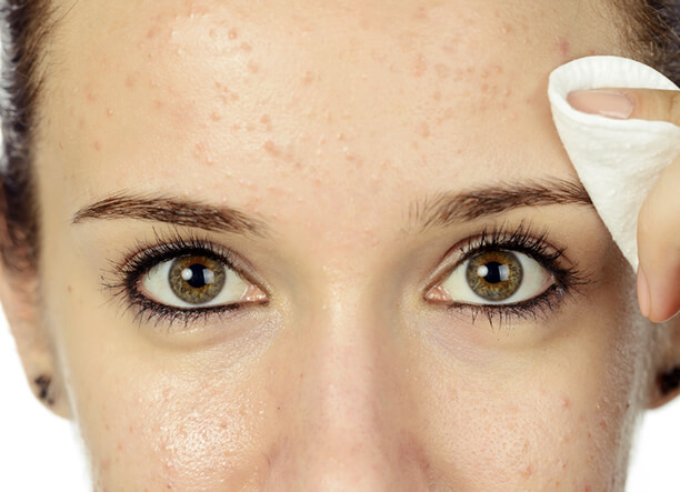 Woman before getting anti-ageing treatment in Inverness at Emma J Aesthetics