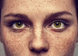 a lady with freckles and hyperpigmentation in inverness