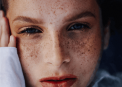 A girl before hyperpigmentation treatment in Inverness