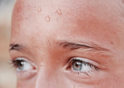 Excessive sweating