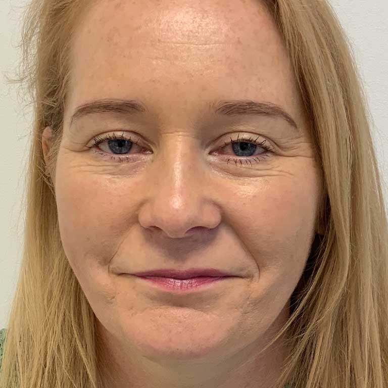 Dermal Fillers Inverness Loss of Volume Emma J Aesthetics