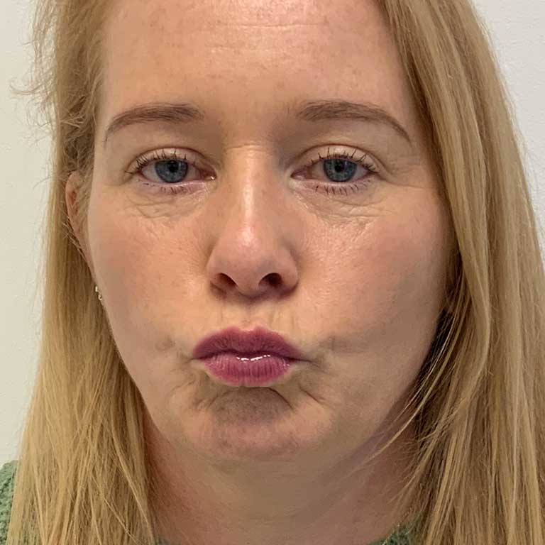 Dermal Fillers Inverness Loss of Volume Emma J Aesthetics