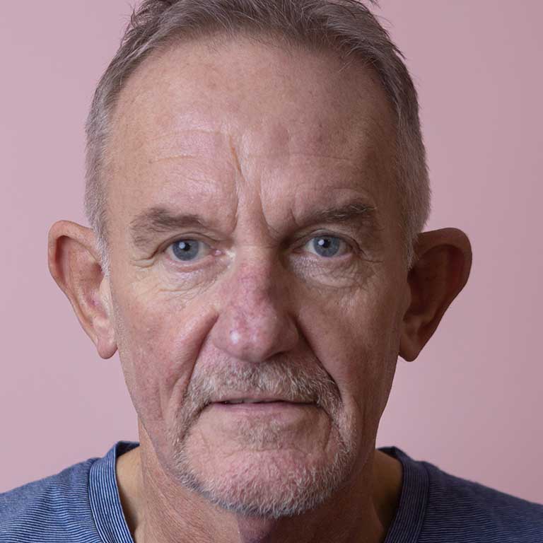 Dermal Fillers Inverness Loss of Volume Emma J Aesthetics