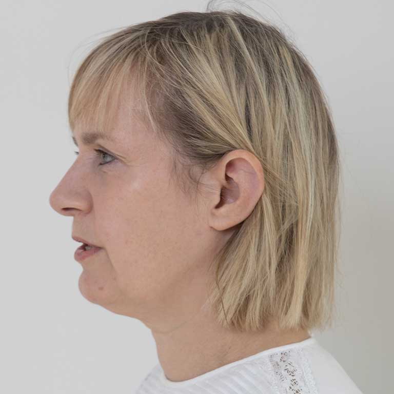 Dermal Fillers Inverness Loss of Volume Emma J Aesthetics