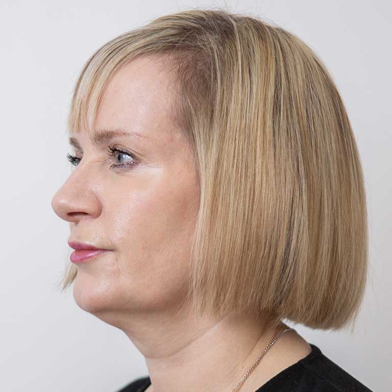 Dermal Fillers Inverness Loss of Volume Emma J Aesthetics