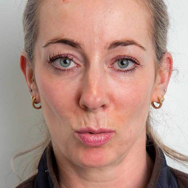 Dermal Fillers Inverness Loss of Volume Emma J Aesthetics