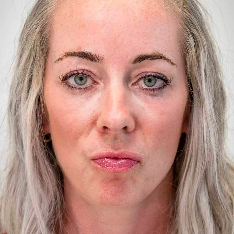 Dermal Fillers Inverness Loss of Volume Emma J Aesthetics