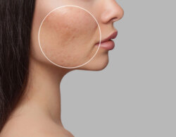 Woman before dermal filler treatment in Inverness