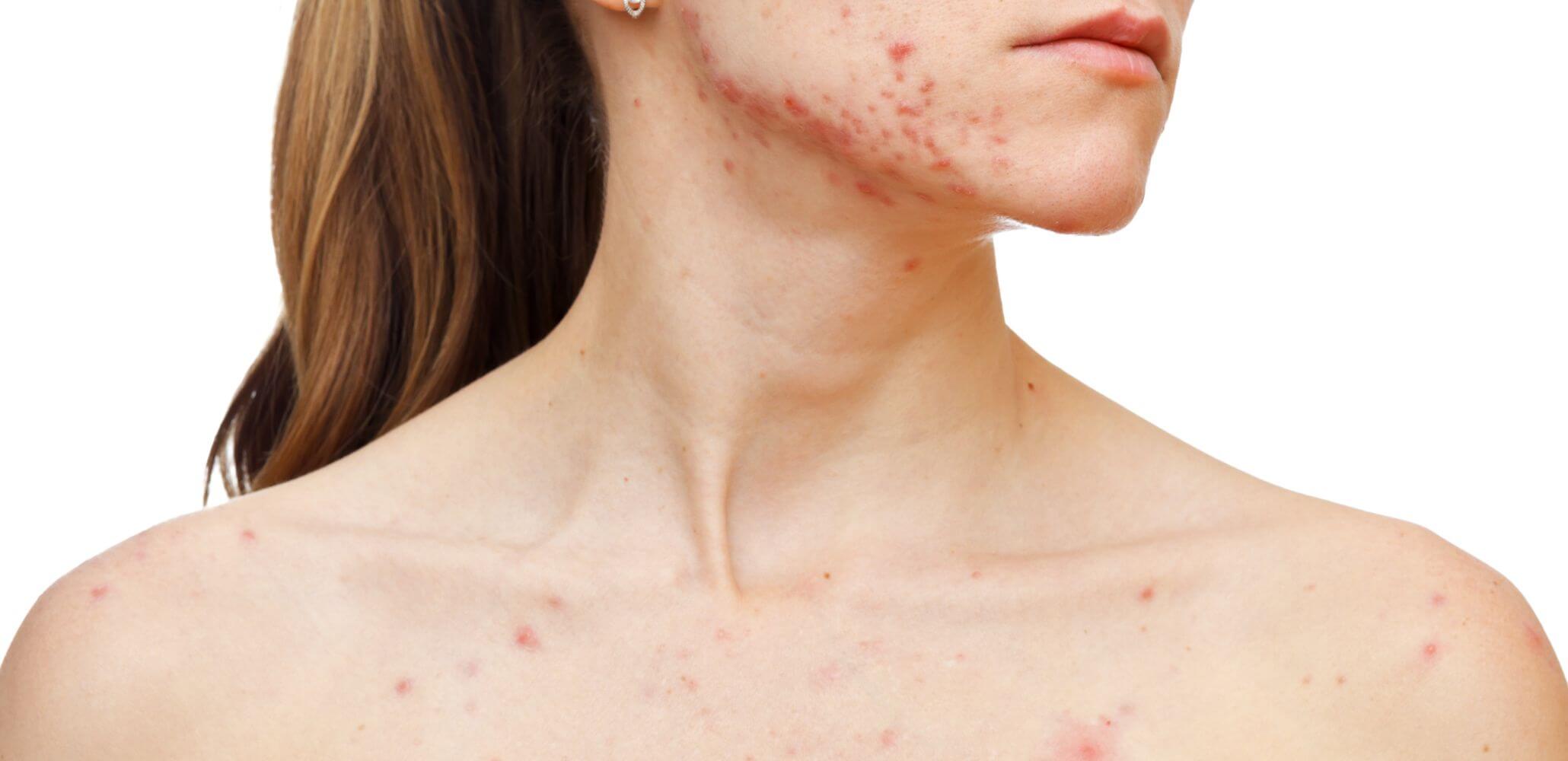 Woman with acne | Emma J Aesthetics | Inverness