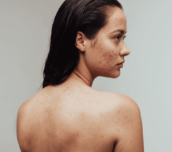 woman with smooth skin and no acne scars after aesthetics treatment with emma J in Inverness